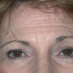 Blepharoplasty Before & After Patient #2788