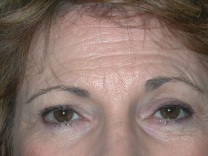 Blepharoplasty Before & After Patient #2788