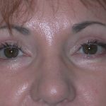 Blepharoplasty Before & After Patient #2788