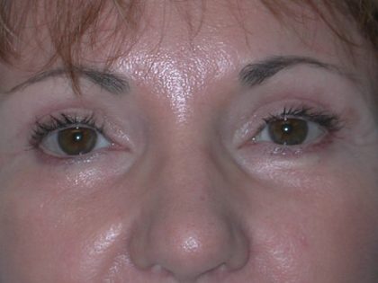 Blepharoplasty Before & After Patient #2788
