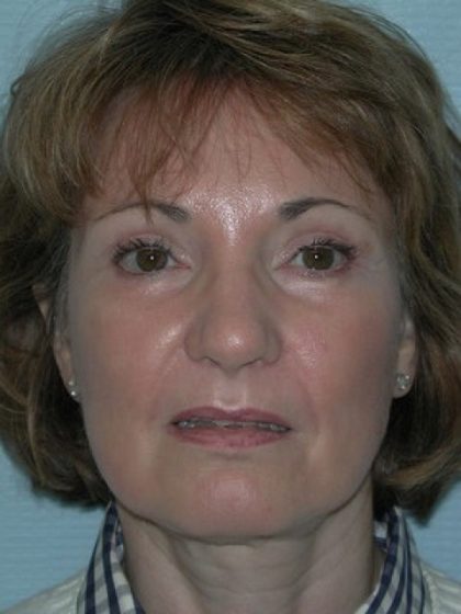 Blepharoplasty Before & After Patient #2788