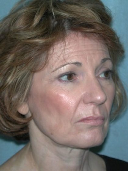 Blepharoplasty Before & After Patient #2788