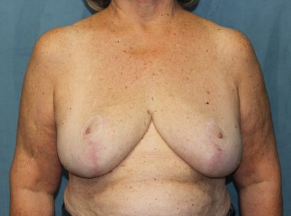 Breast Reduction Before & After Patient #2596