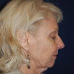 Facelift Before & After Patient #3060