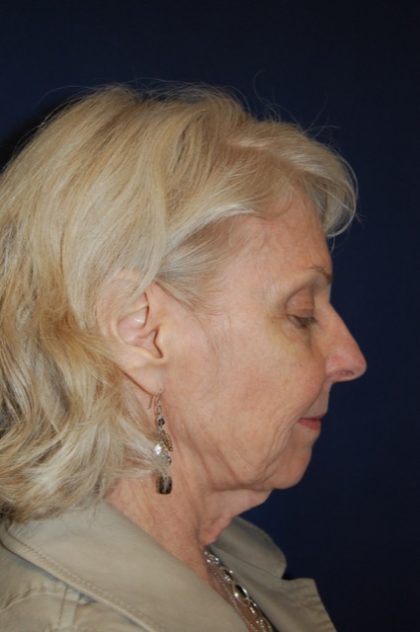 Facelift Before & After Patient #3060