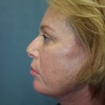 Facelift Before & After Patient #3101