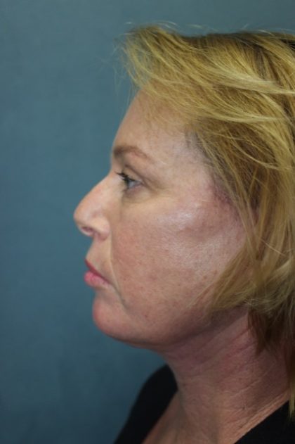 Facelift Before & After Patient #3101