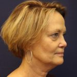 Facelift Before & After Patient #3085