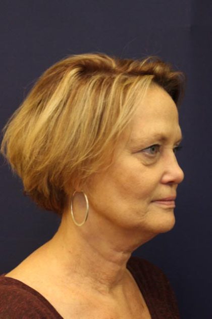 Facelift Before & After Patient #3085