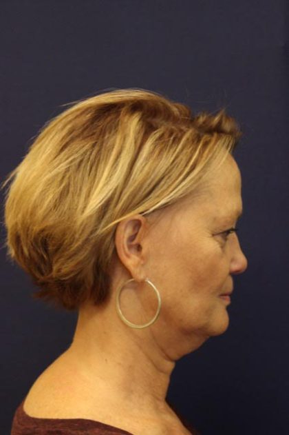 Facelift Before & After Patient #3085