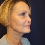 Facelift Before & After Patient #3085