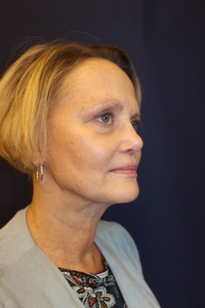 Facelift Before & After Patient #3085