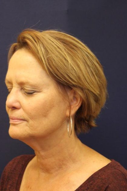 Facelift Before & After Patient #3085