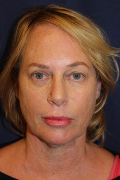 Facelift Before & After Patient #3101