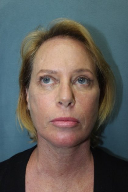 Facelift Before & After Patient #3101