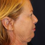 Facelift Before & After Patient #3101