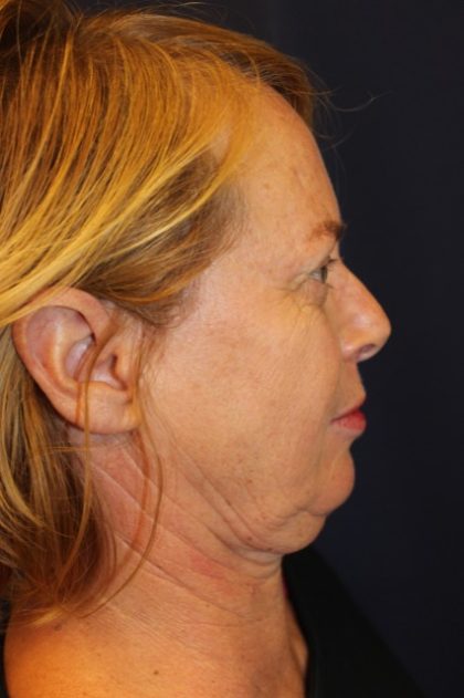Facelift Before & After Patient #3101