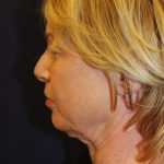 Facelift Before & After Patient #3101