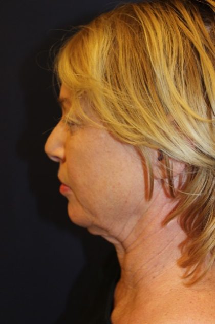 Facelift Before & After Patient #3101