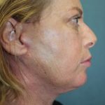 Facelift Before & After Patient #3101