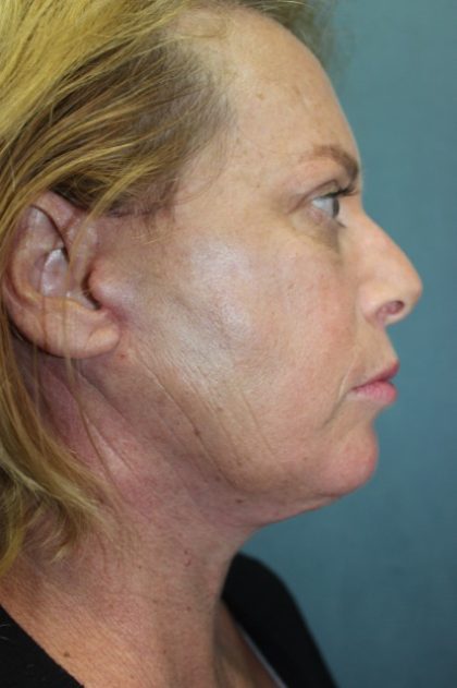 Facelift Before & After Patient #3101