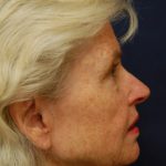 Facelift Before & After Patient #3144