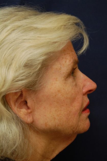 Facelift Before & After Patient #3144
