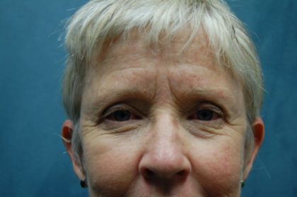 Facelift Before & After Patient #3026