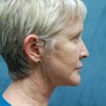 Facelift Before & After Patient #3026