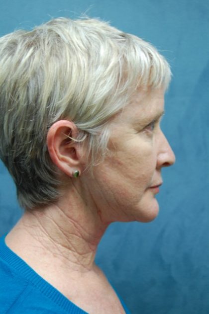 Facelift Before & After Patient #3026