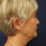 Facelift Before & After Patient #3026