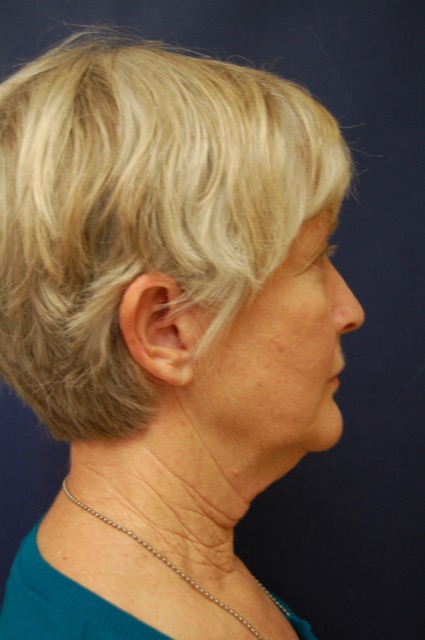 Facelift Before & After Patient #3026