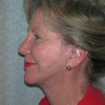 Facelift Before & After Patient #3033