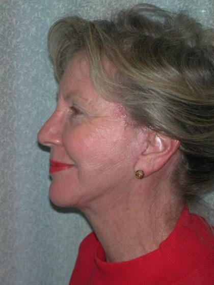 Facelift Before & After Patient #3033