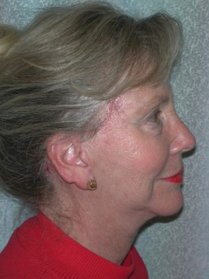 Facelift Before & After Patient #3033