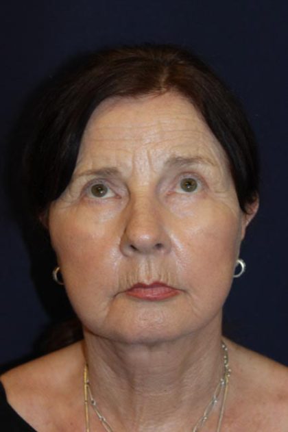 Facelift Before & After Patient #3162