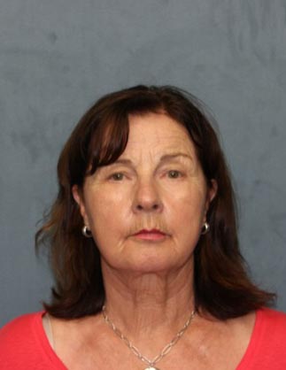 Facelift Before & After Patient #3162