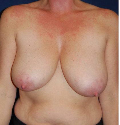 Breast Augmentation Before & After Patient #3481