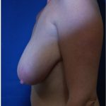 Breast Augmentation Before & After Patient #3481