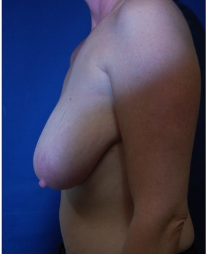 Breast Augmentation Before & After Patient #3481