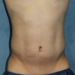 Liposuction Before & After Patient #1675