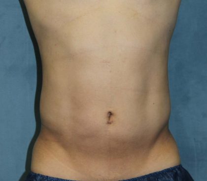 Liposuction Before & After Patient #1675