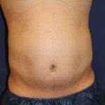 Liposuction Before & After Patient #1675