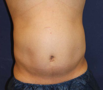 Liposuction Before & After Patient #1675