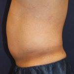 Liposuction Before & After Patient #1675