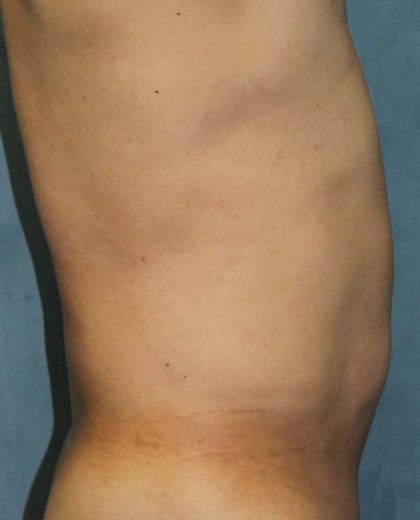 Liposuction Before & After Patient #1675