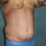 Liposuction Before & After Patient #1808