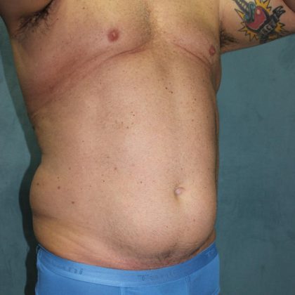 Liposuction Before & After Patient #1808