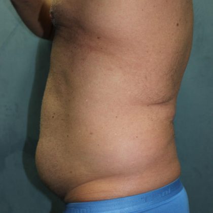 Liposuction Before & After Patient #1808