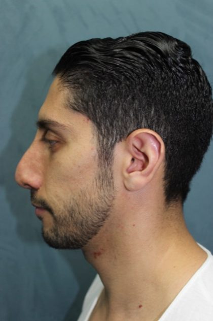 Rhinoplasty Before & After Patient #1904